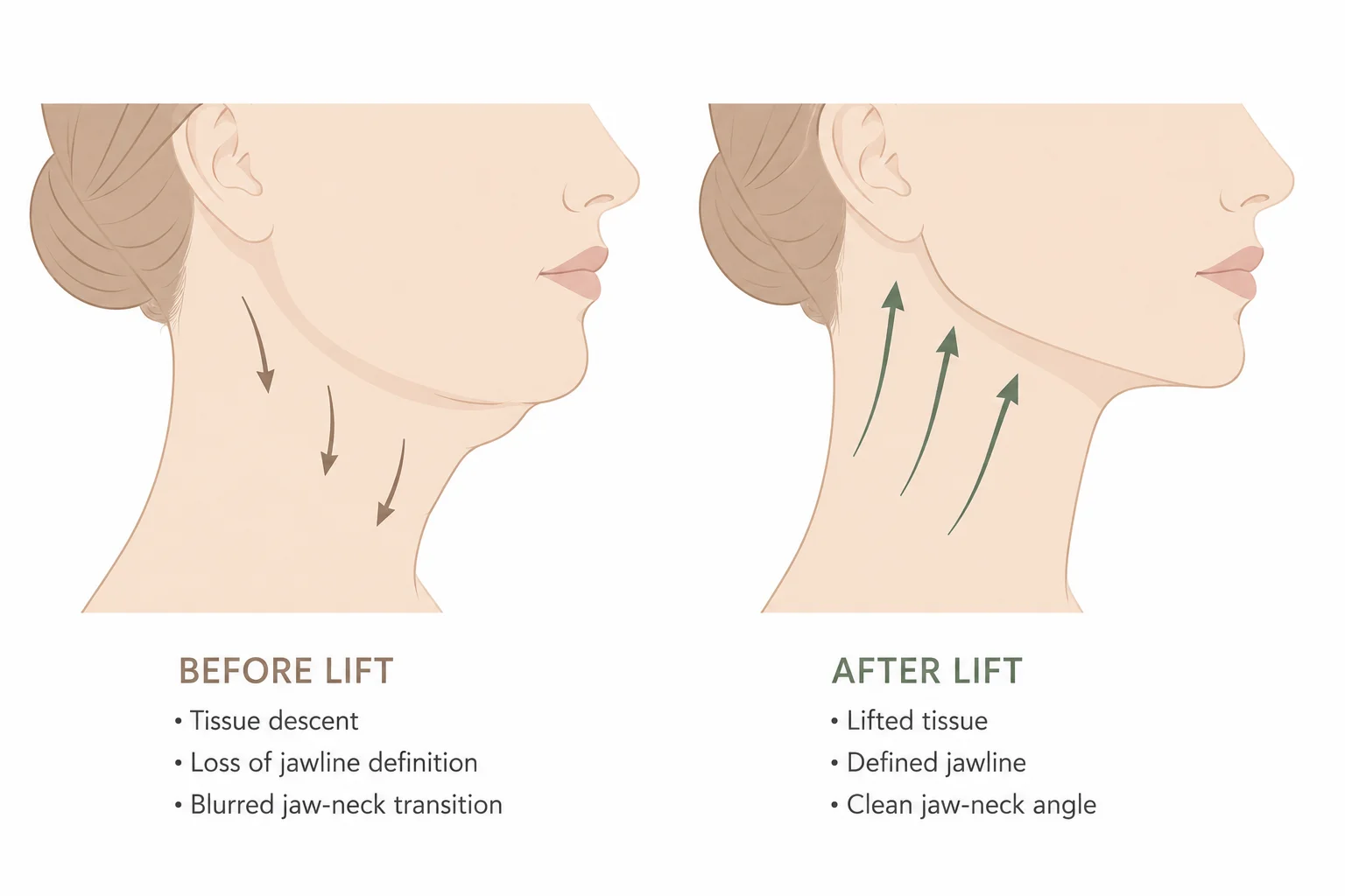 Deep Neck Lift Results